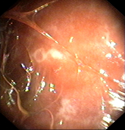 結核性胸膜炎症狀