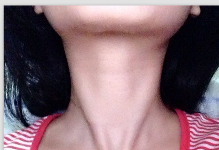 橋本甲狀腺炎症狀