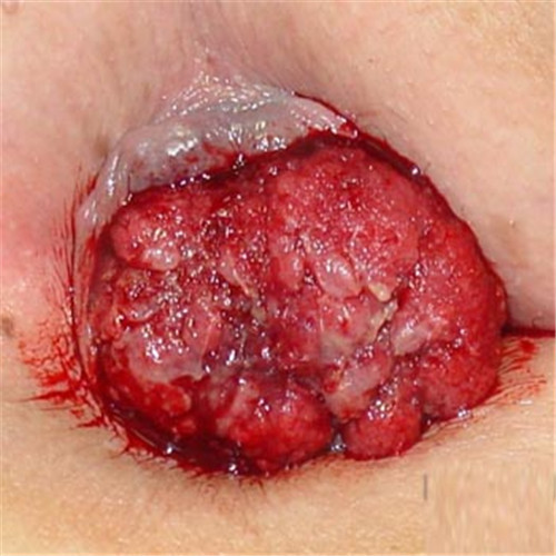 潰瘍性結腸炎微創手術