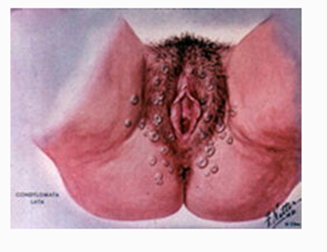 妊娠合併梅毒陰性嚴重