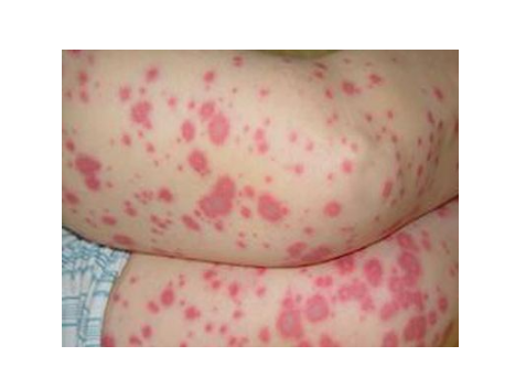 玫瑰糠疹母斑