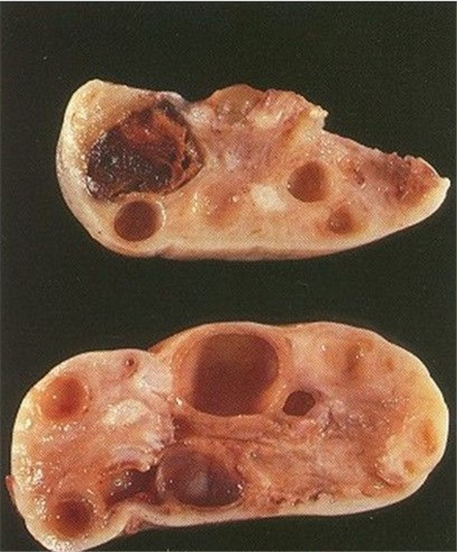 雙側多囊卵巢囊腫