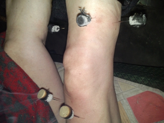 膝蓋骨質增生 (49) 