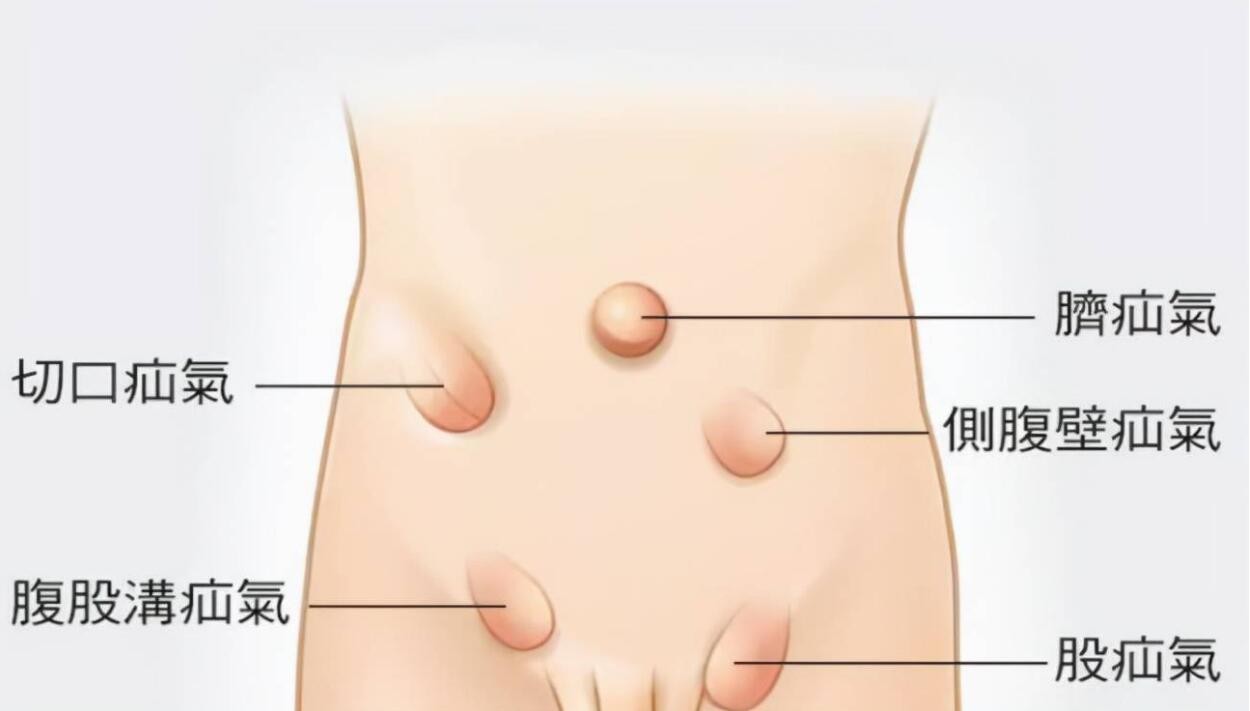 男寶寶疝氣的症狀