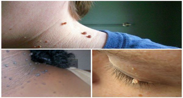 皮膚纖維瘤 (41) 