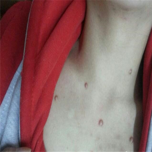 胸部皮脂腺痣