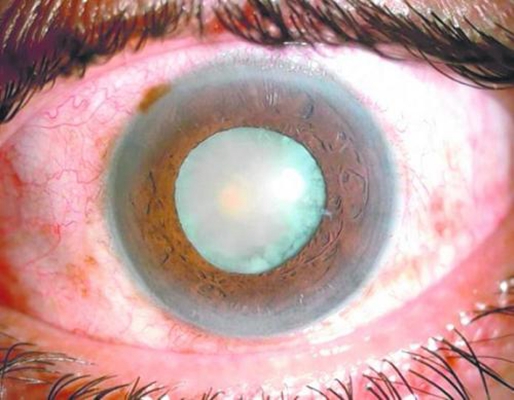 白內障的早期症狀