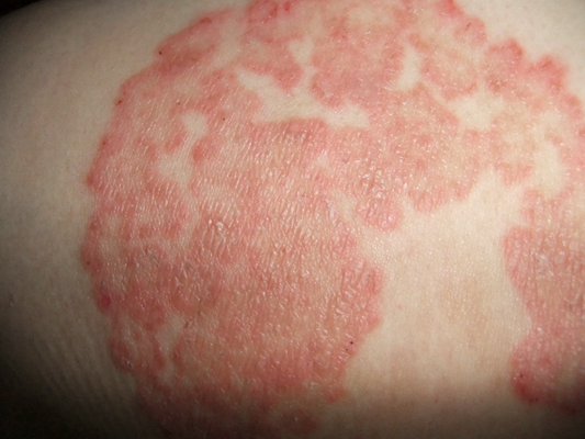 小兒猩紅熱症狀