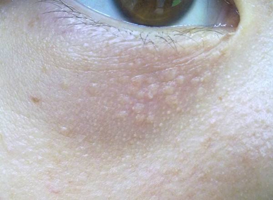 粟丘疹 (7) 