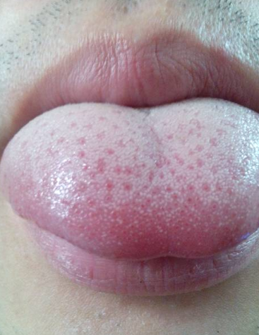 胃炎的症狀舌頭