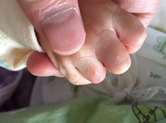 長水痘的症狀 (63) 