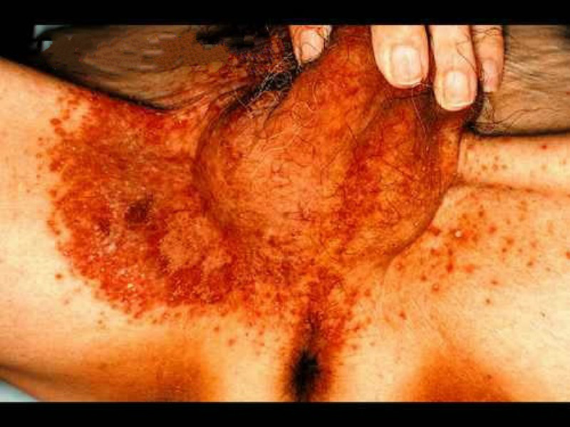 中年男性皮膚念珠菌病