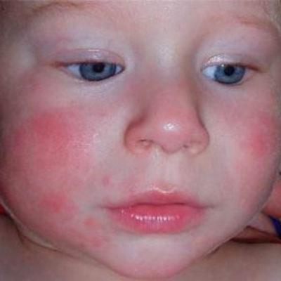 小兒猩紅熱症狀