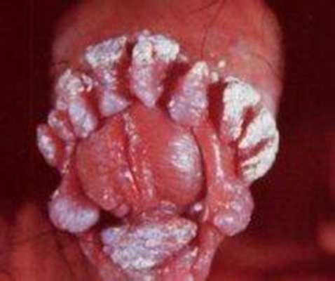 性病性淋巴肉芽腫套圖 (42) 