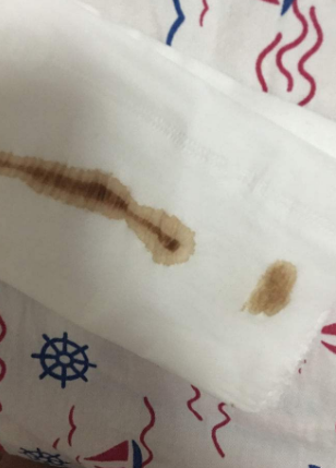 白帶帶有褐色分泌物 (54) 