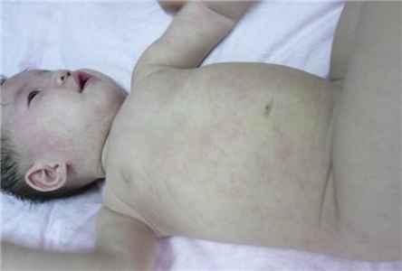 小兒急疹的症狀 (34) 