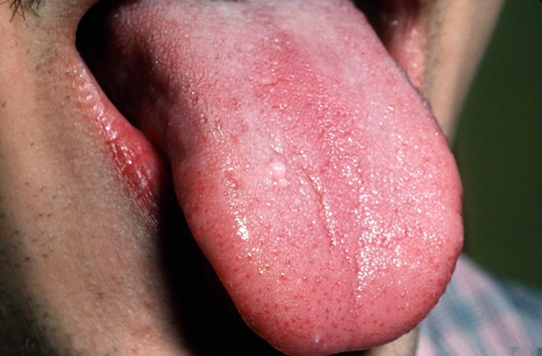 皮膚纖維瘤 (44) 