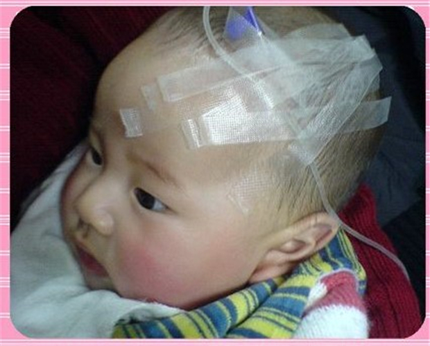 治療寶寶先天性喉喘鳴