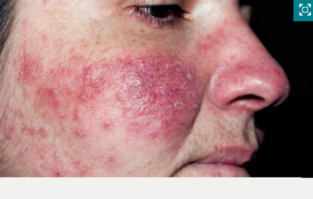 激素臉排毒症狀 (61) 