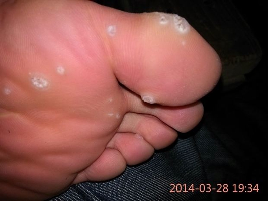 足蘚初期症狀