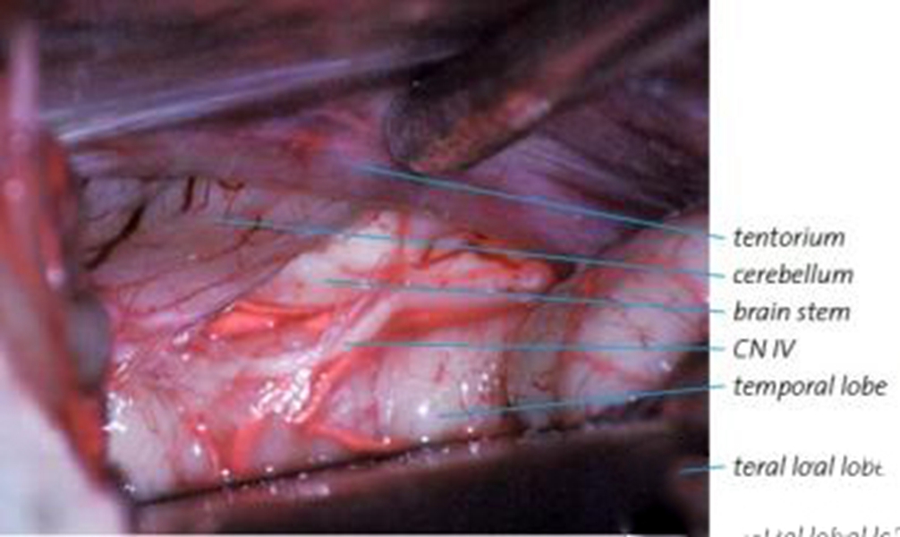 煙霧病血管造影
