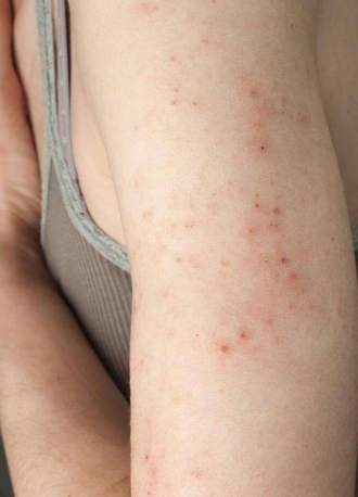 體內有寄生蟲的症狀 (64) 