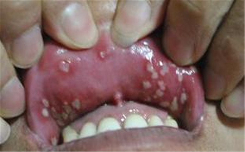 白塞病嘴唇起泡