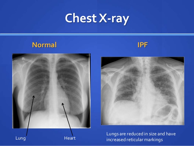 ＿正常肺部與肺纖維化X線對比