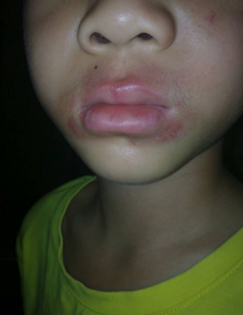 嘴唇潰瘍