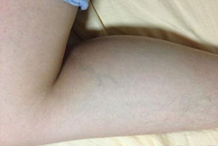 輕度小腿靜脈曲張 