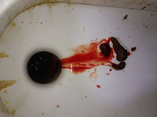 腸癌的症狀 (44) 