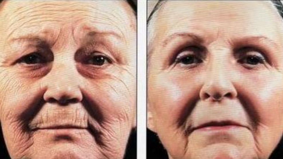 老年人皮膚老化