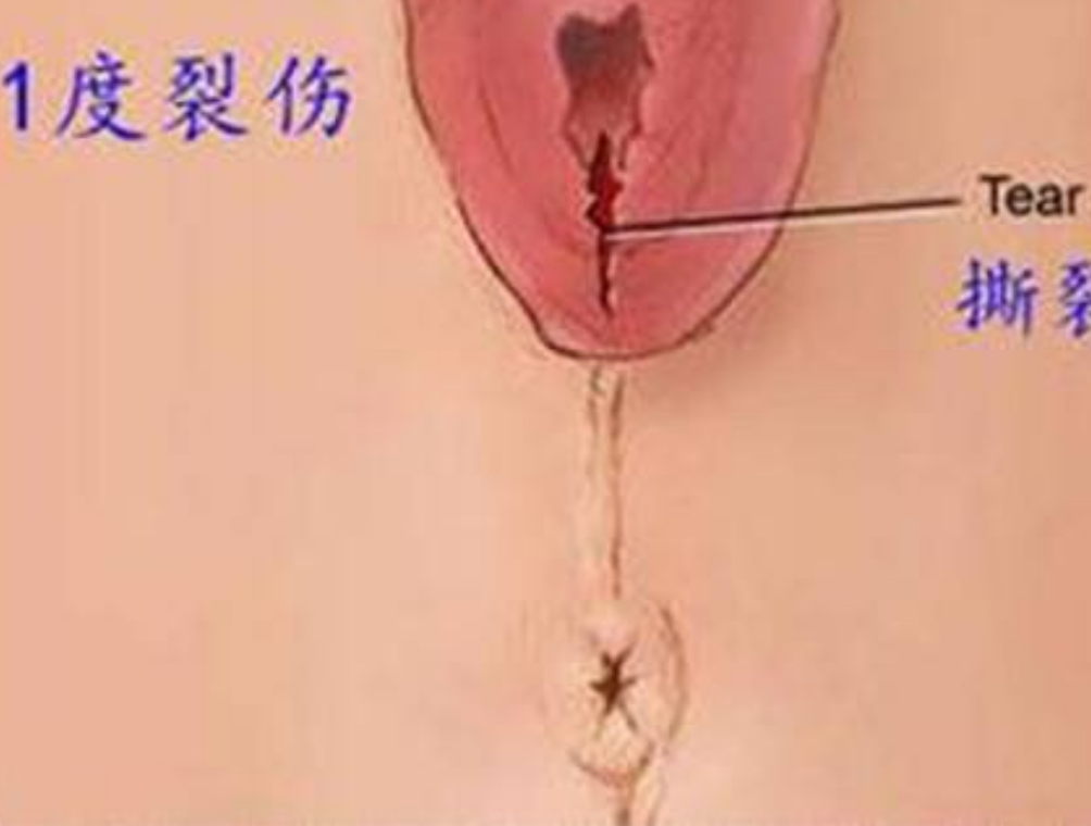 順產時會陰撕裂