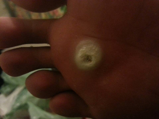 腳底蹠疣早期