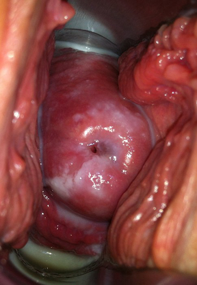 子宮肥大圖 (42) 