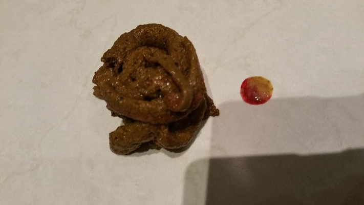 直腸癌晚期症狀 (41) 