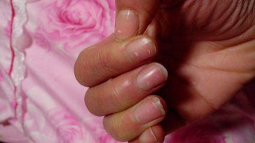 蛔蟲病症狀指甲表現