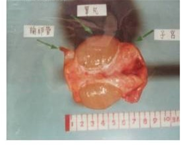 男性假兩性畸形睪丸