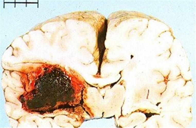 左大腦中動脈栓塞腦梗塞