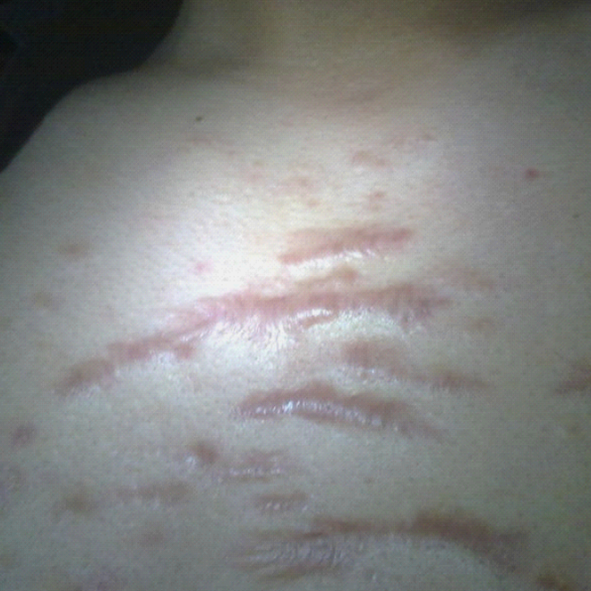 肚子皮囊炎怎麼治療 