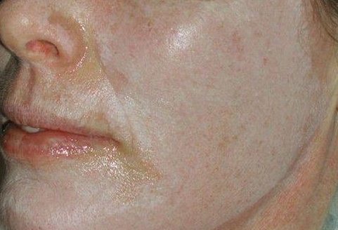 磨皮手術效果圖 (37) 