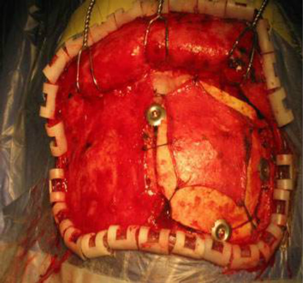 硬腦膜外熱血腫 