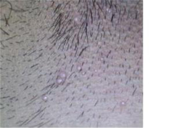 男性肉芽狀假性溼疣男性