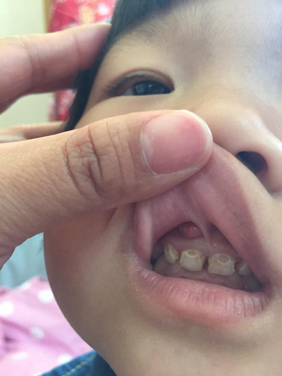 牙齦炎和牙周炎