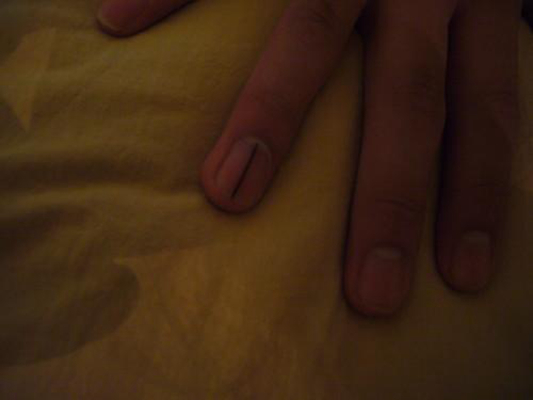 手指甲上有豎紋圖解 (50) 