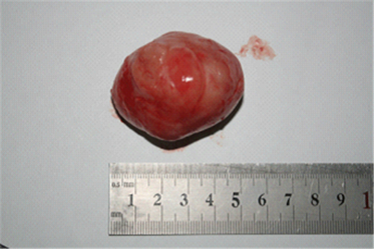 摘除的乳腺纖維瘤