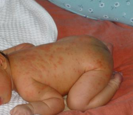 寶寶紅屁屁照片 (44) 