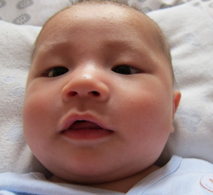 新生兒胎毒的症狀