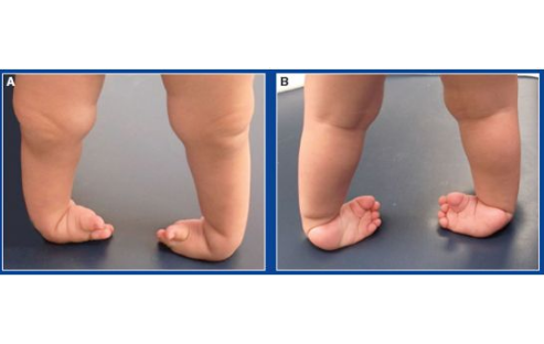 痙攣型腦癱 (52) 
