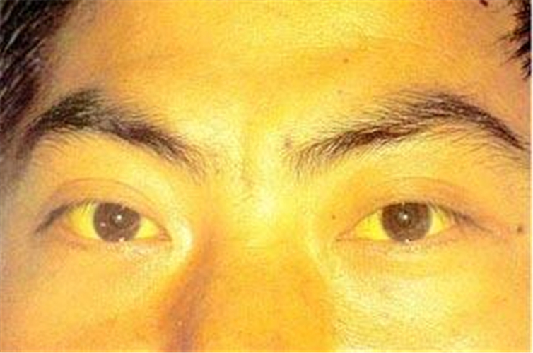 酒精肝面部表現